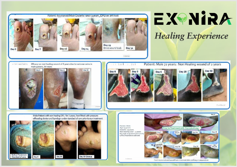 Exonira healing case studies showing before and after progress on diabetic foot ulcers and chronic wounds